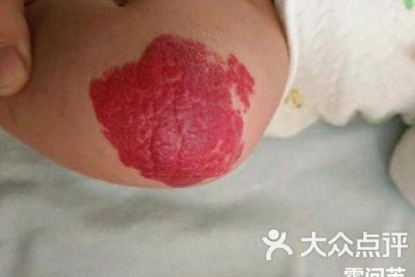红色胎记算命分析