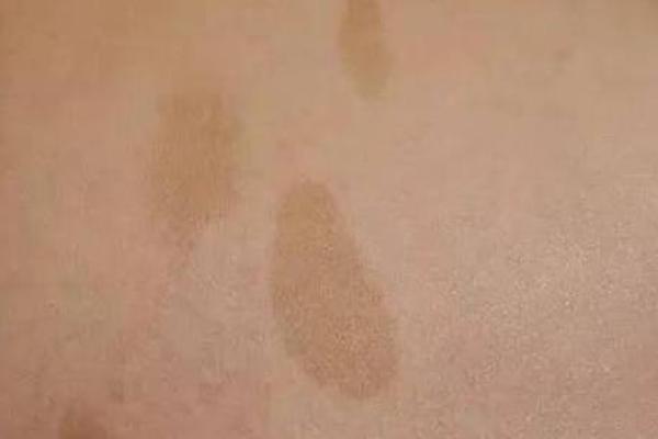 大腿上胎记的位置与算命