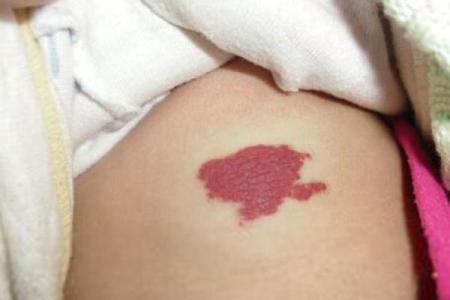 大腿上胎记的位置与算命