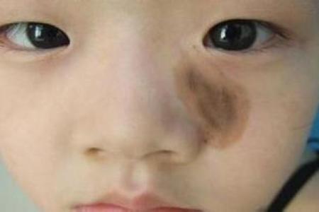 算命胎记