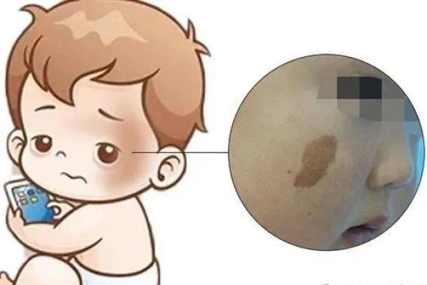 胎记算命方法介绍