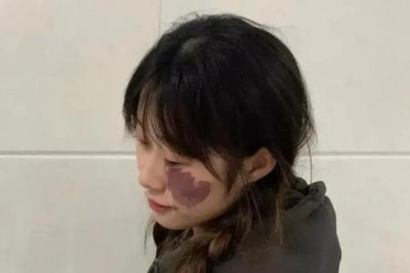 算命黑色胎记